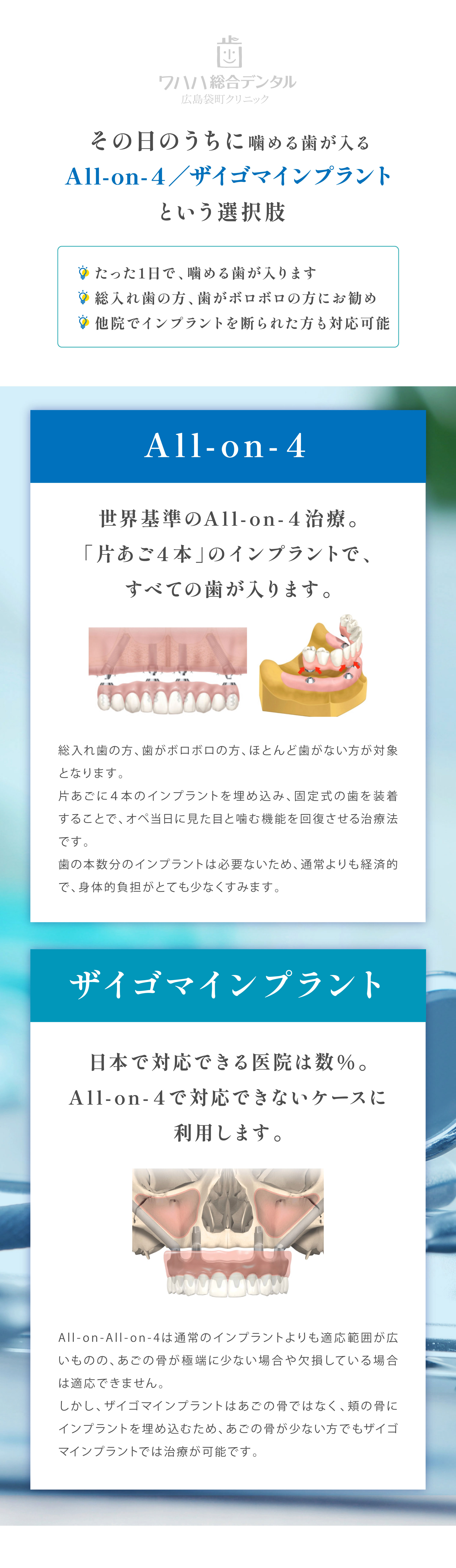 ワハハ総合デンタル広島袋町クリニックその日のうちに噛める歯が入る All-on-4ザイゴマインプラントという選択肢 たった1日で、噛める歯が入ります 総入れ歯の方、歯がボロボロの方にお勧め 他院でインプラントを断られた方も対応可能All-on-4世界基準のA1l-on-4治療。「片あご4本」のインプラントで、すべての歯が入ります。総入れ歯の方、歯がボロボロの方、ほとんど歯がない方が対象となります。片あごに4本のインプラントを埋め込み、固定式の歯を装着することで、オペ当日に見た目と噛む機能を回復させる治療法です。歯の本数分のインプラントは必要ないため、通常よりも経済的で、身体的負担がとても少なくすみます。ザイゴマインプラント 日本で対応できる医院は数％。All-on-4で対応できないケースに利用します。All-on-All-on-4は通常のインプラントよりも適応範囲が広いものの、あごの骨が極端に少ない場合や欠損している場合は適応できません。しかし、ザイゴマインプラントはあごの骨ではなく、頬の骨にインプラントを埋め込むため、あごの骨が少ない方でもザイゴマインプラントでは治療が可能です。
